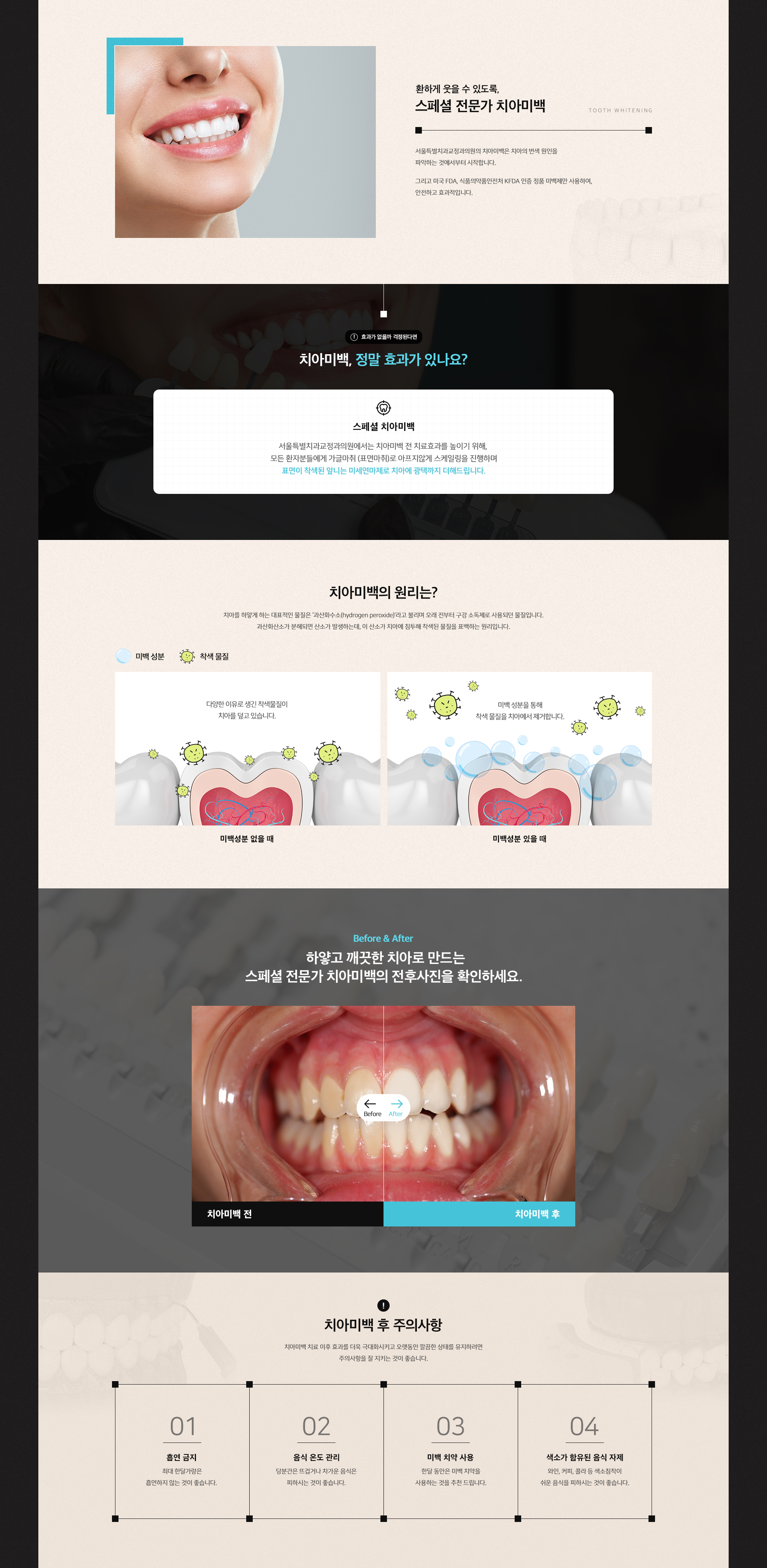 스페셜 전문가 치아미백